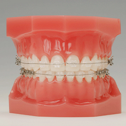 orthodontic-img05